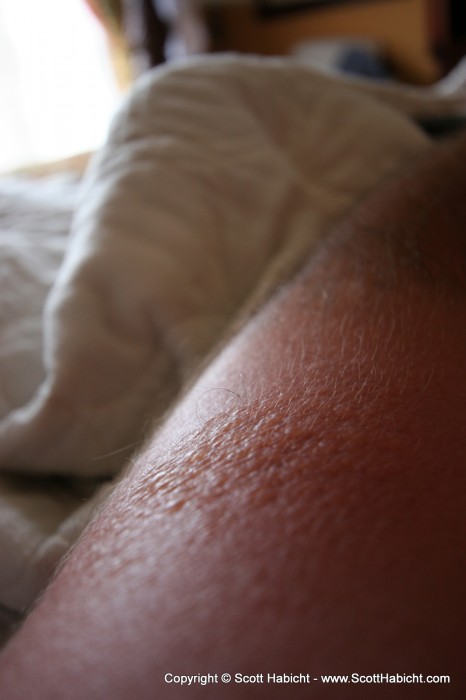 My sunburn is starting to blister. Sexy!