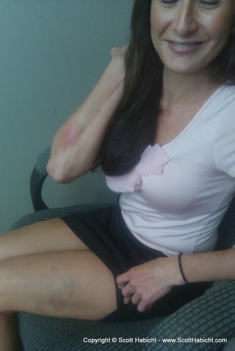 Bridey shows off her mountain biking bruises.